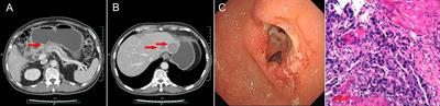 Changes in Neutrophil to Lymphocyte Ratio, Lymphocyte to Monocyte Ratio, and Platelet to Lymphocyte Ratio During Palliative Radiotherapy May Predict Efficacy of Immune Checkpoint Inhibitor as Re-Challenge Treatment in Advanced Gastric Cancer: A Case Report